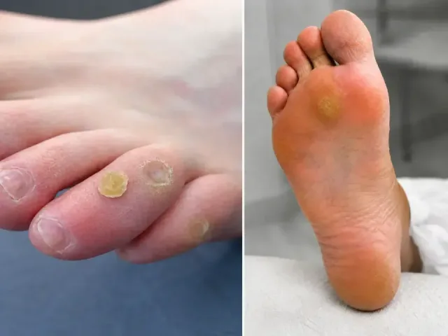 Reducerea presiunii în zonele afectate - Podiatry service