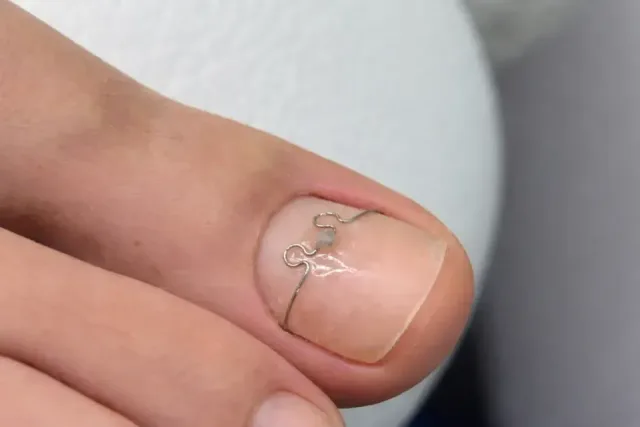 Corecția unghiei încarnate - Podiatry service